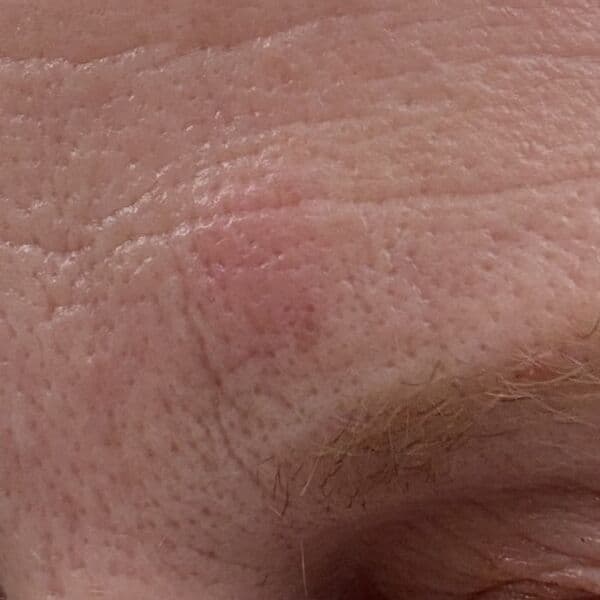 After — Irritation