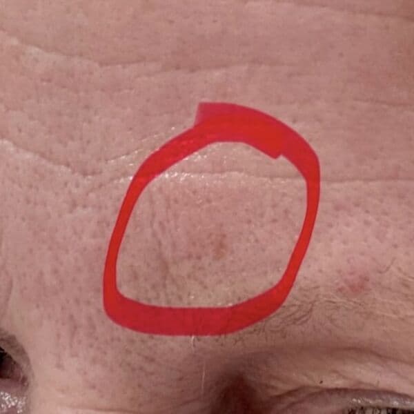 Before — Irritation